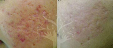 acne scar treatment in gurgaon